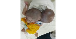 কুষ্টিয়া সদর হাসপাতালে দৈত্যাকার টিউমারের সফল অস্ত্রোপচার