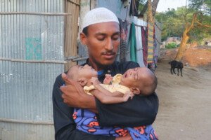 এক দেহে দুই প্রাণ: দারিদ্র্যের দেয়ালে থমকে দুই শিশুর নতুন জীবনের স্বপ্ন