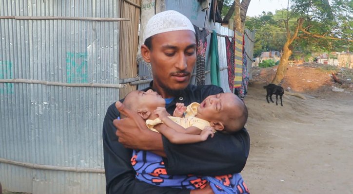 এক দেহে দুই প্রাণ: দারিদ্র্যের দেয়ালে থমকে দুই শিশুর নতুন জীবনের স্বপ্ন