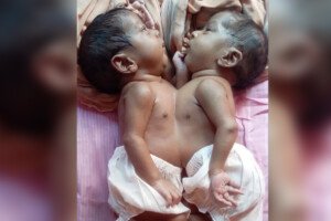 জোড়া লাগা যমজ শিশু চিকিৎসাধীন অবস্থায় মৃত্যু