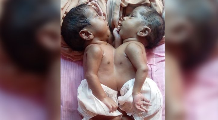 জোড়া লাগা যমজ শিশু চিকিৎসাধীন অবস্থায় মৃত্যু